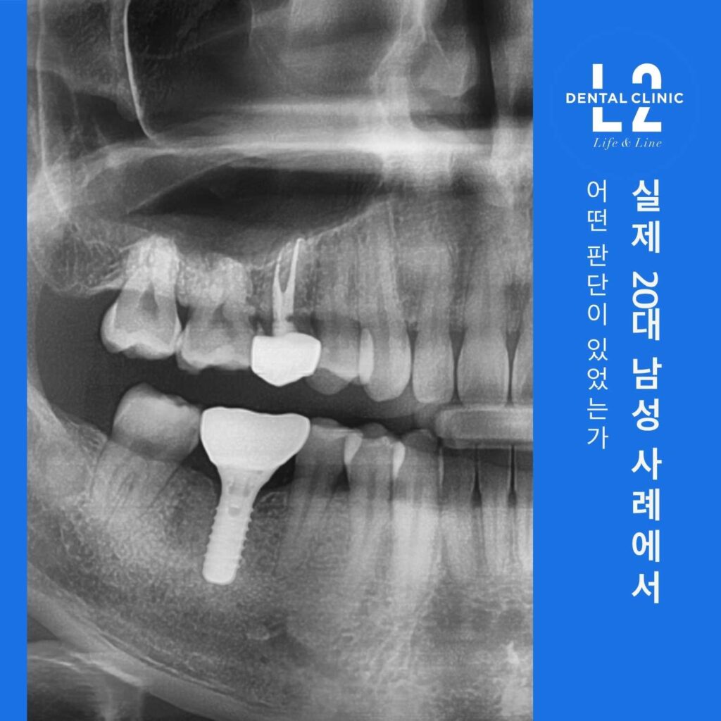 20대 남성 환자의 어금니 임플란트 식립 상태를 보여주는 파노라마 X-ray